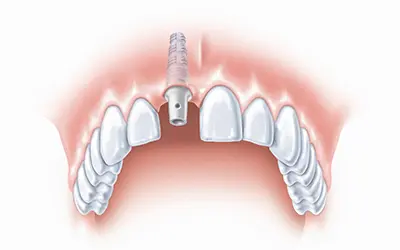 Dr Dimitrije Stojanović Dental Clinic Implanti